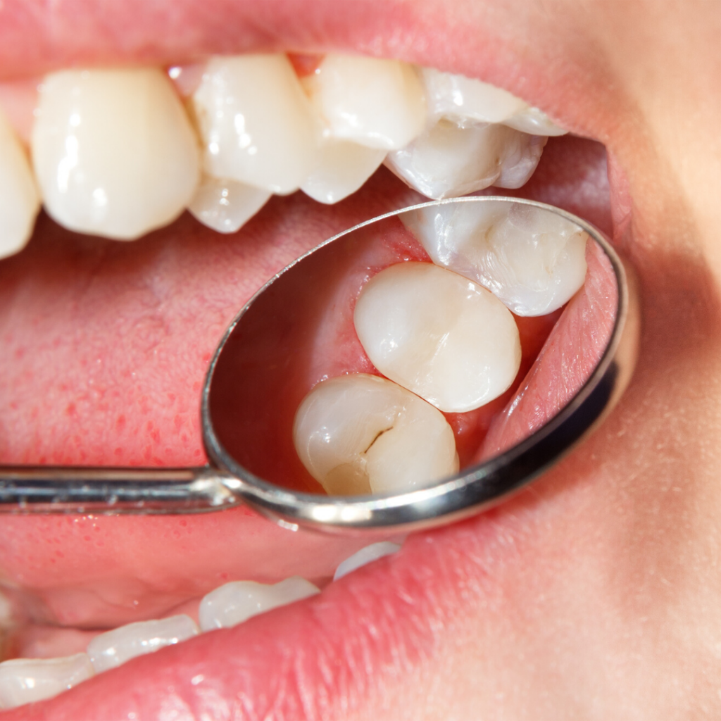 Zahnfüllungen in Zahnfarbe - Zahnarztpraxis Dr. Julian Simon