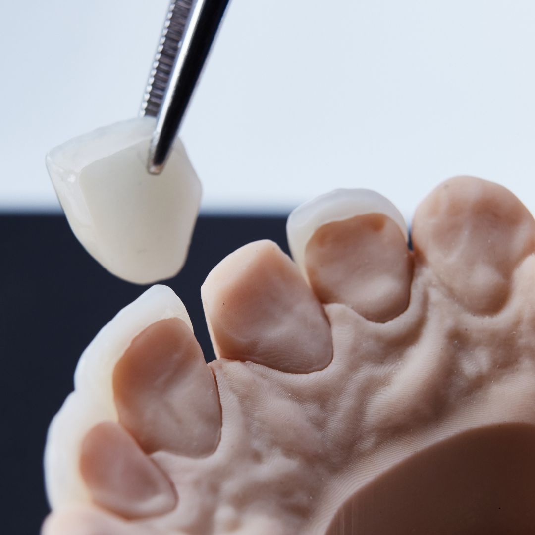 Veneers